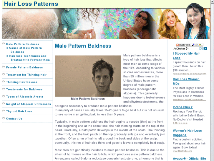 www.hairlosspatterns.com