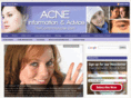 thecommonacne.com