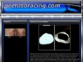 pectusbracing.com