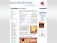 dental-implant-guide.com