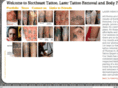 northeastlasertattooremoval.com
