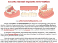 atlantadentalimplant.com