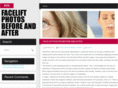 faceliftphotosbeforeandafter.com