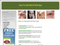 howtogetridofpinkeye.net