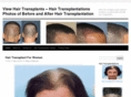 hair-transplantations.com