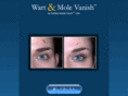 wart-mole-vanish.info