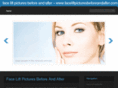 faceliftpicturesbeforeandafter.com