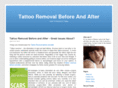 tattooremovalbeforeandafter.biz