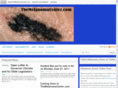 themelanomacenter.com