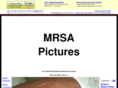 mrsa-pictures.com