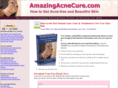 amazingacnecure.com