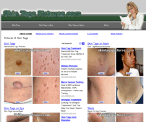 skintagspictures.com: Skin Tag Pictures | Photos of Skin Tags
Pictures of Skin Tags on the human body as well as some wart pictures.