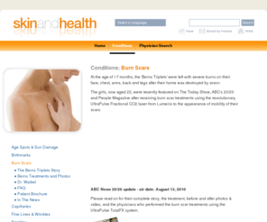 burns-triplets.com: Lumenis Skin and Health: Burn Scars
