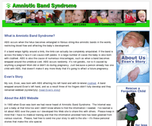 amnioticbandsyndrome.com: Amniotic Band Syndrome - ABS is a set of congenital birth defects -
Amniotic Band Syndrome - Amniotic Band Syndrome is a set of congenital birth defects. Learn about ABS, read personal stories, and add your story to the site. Amniotic Band Syndrome is a set of congenital birth defects. Learn...