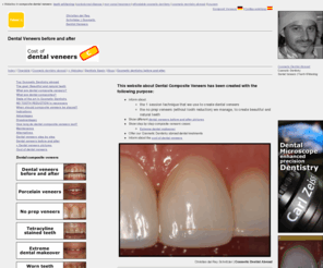 compositeveneers.net: Dental composite veneers before and after
Information about cost of dental veneers and cosmetic dentistry abroad in Spain.Before and after pictures.