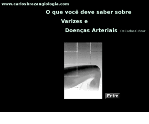 carlosbrazangiologia.com: VARIZES E  DOENAS ARTERIAIS  Criada por CB em  2002 - Rio de Janeiro Brasil
Varizes e Doenas Arteriais