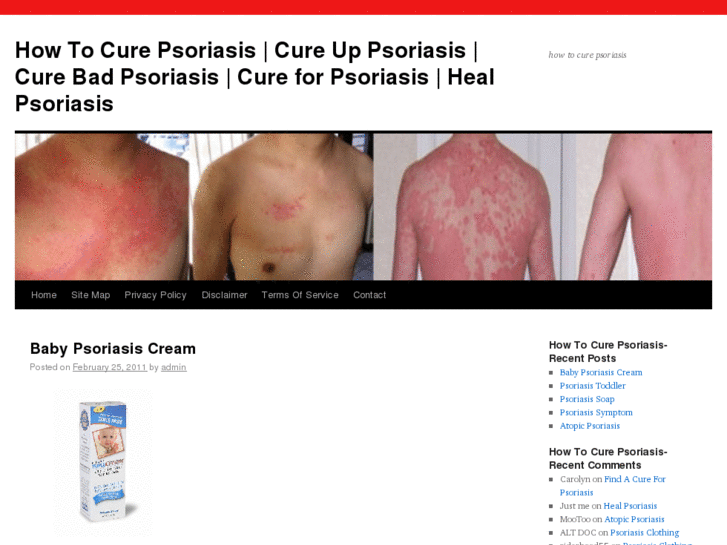 www.howtocurepsoriasis.info